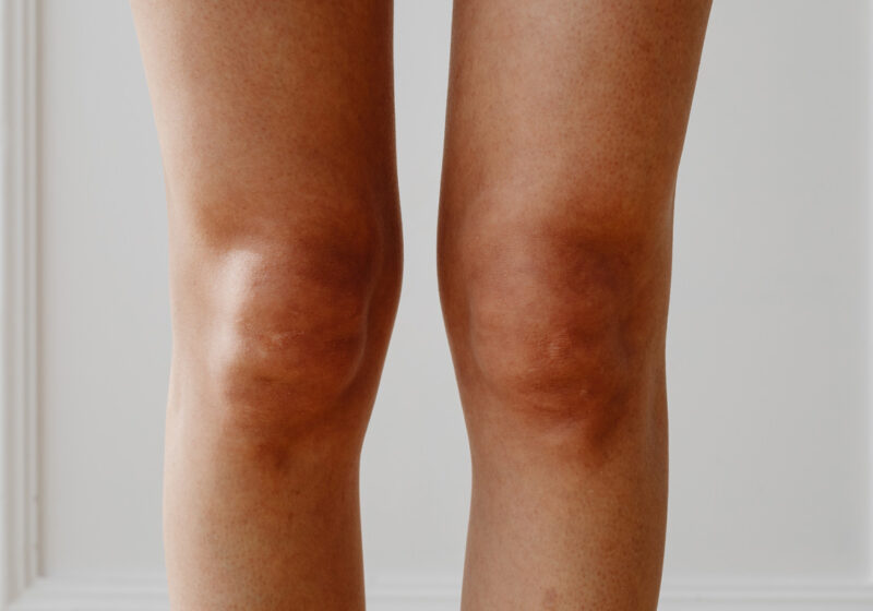 Gelenkschmerzen! Warum nicht nur ältere „Semester“ betroffen sein können