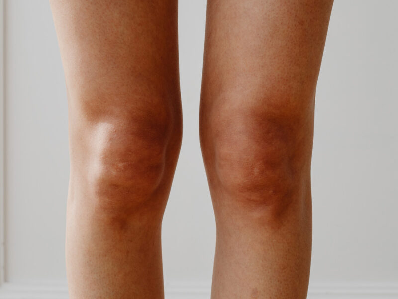 Gelenkschmerzen! Warum nicht nur ältere „Semester“ betroffen sein können